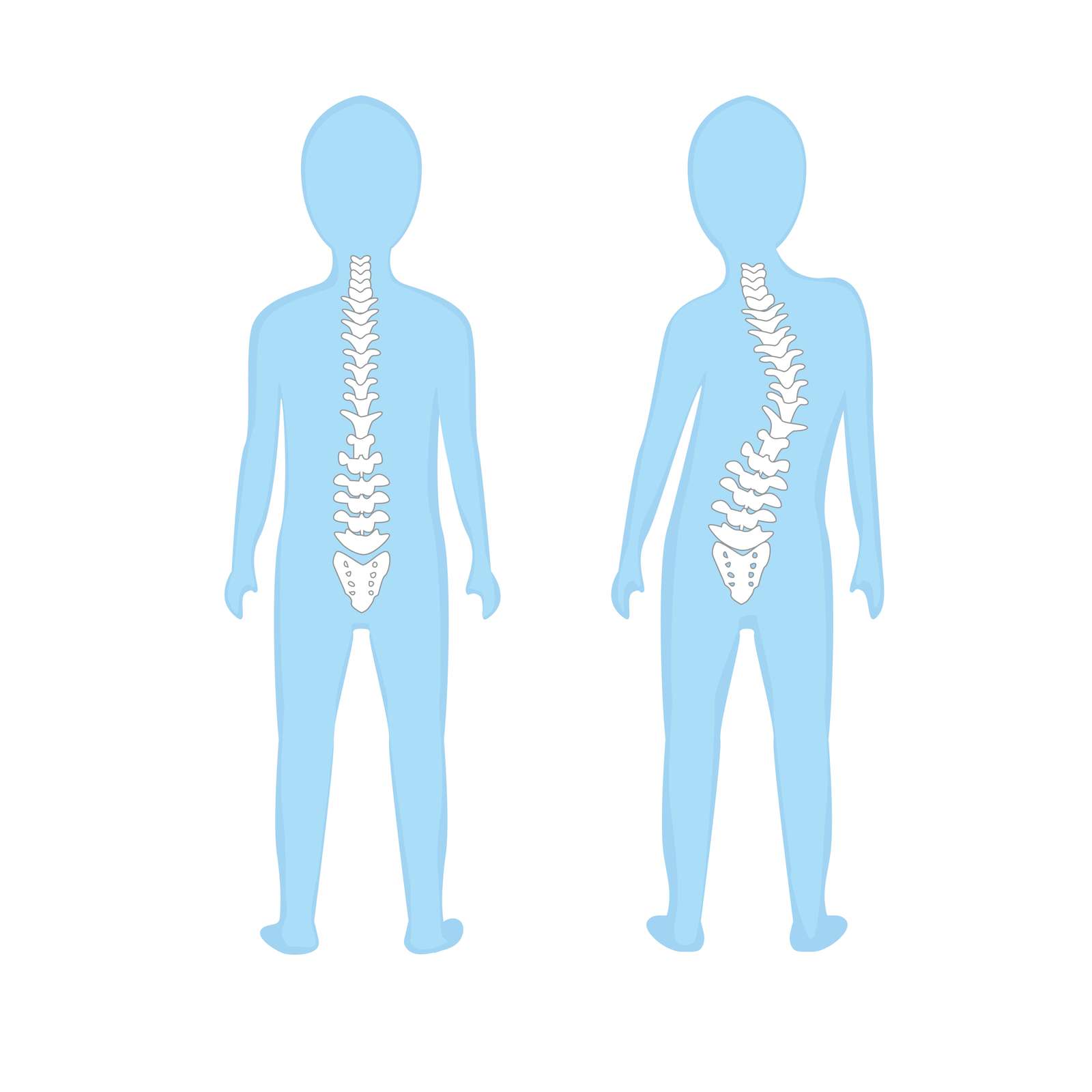 Позвонки ребенка. Сколиоз схематично. Силуэт позвоночника человека. Искривление позвоночника силуэт.